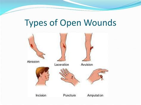 Types Of Wounds Chart
