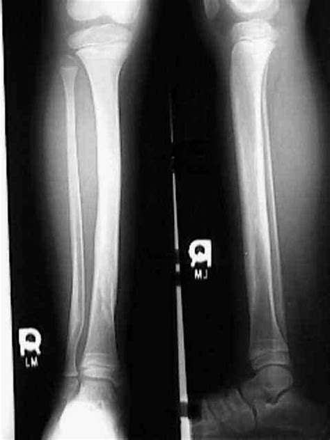 Er A Shift In The Night Pediatric Tibial Fracture