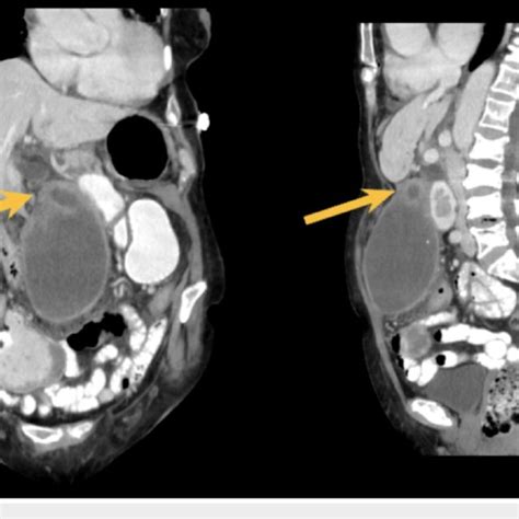 Left Image Coronal Section Ct Abdomenpelvis With Iv Contrast With