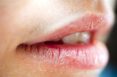 Coronavirus Symptoms Update Lips Mouth And Eyes May Signal A Covid 19