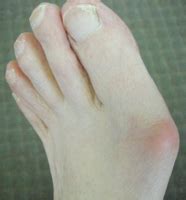 Bunions And Hammer Toes Causes And Treatment Options MyFootShop