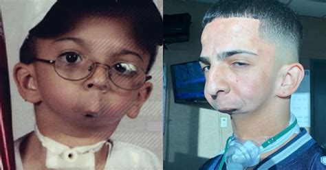 Story Of Man Born Without Jaw Or The Ability To Speak Inspires People