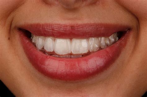 Invisalign Treatment Weston Spencer Dds