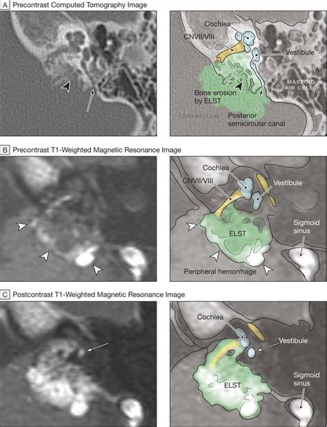 Large Endolymphatic Sac Tumor With Invasion Of The Otic Capsule Download Scientific Diagram