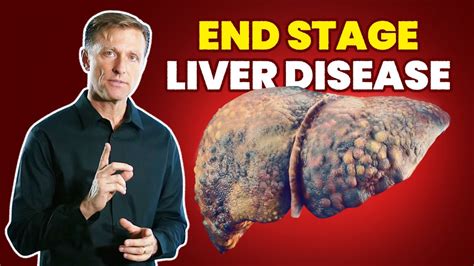 10 Signs Of A Dying Liver End Stage Liver Disease Youtube