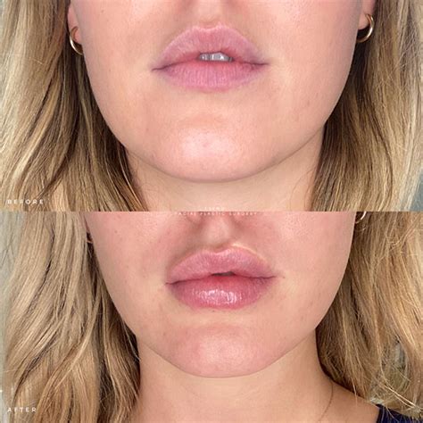 celebrity lip filler before and after