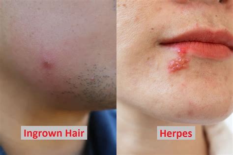 Ingrown Hair Vs Herpes What Are The Differences Hairstylecamp