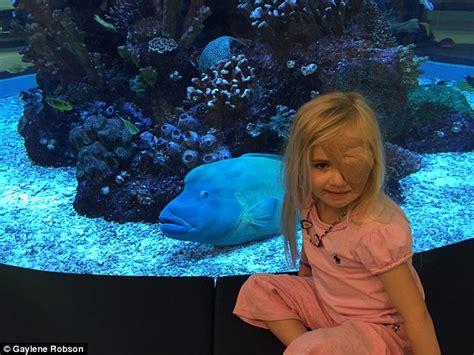 Melbourne Girl Who Went To The Doctor With A Puffy Eye Had A Tumour On