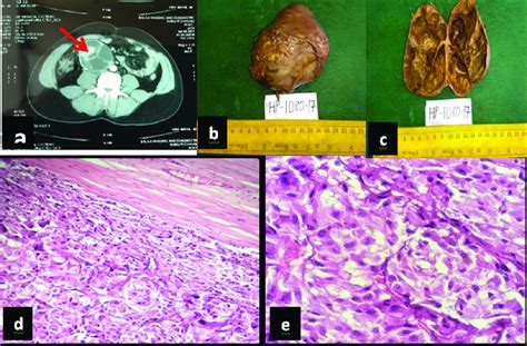 Ct Scancontrast Enhanced Showing Amultiloculated Cyst With Partly