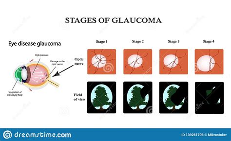 Glaucoma The Field Of Vision In Glaucoma Infographics Vector