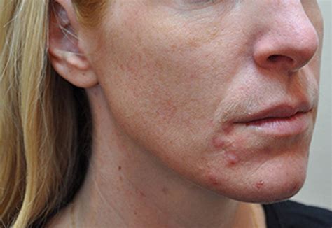 Acne Scar Removal Treatment Calgary Cosmetic Procedures For Acne