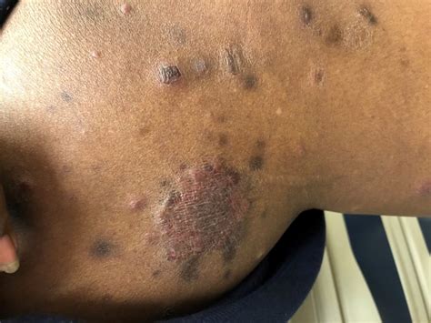 Clinical Challenge Itchy Scaly Rash On The Back Mpr
