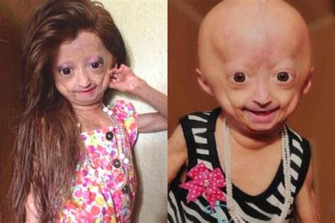 “ya No Siente Dolor” Murió Adalia Rose La Youtuber Que Inspiró La Película “el Curioso Caso De