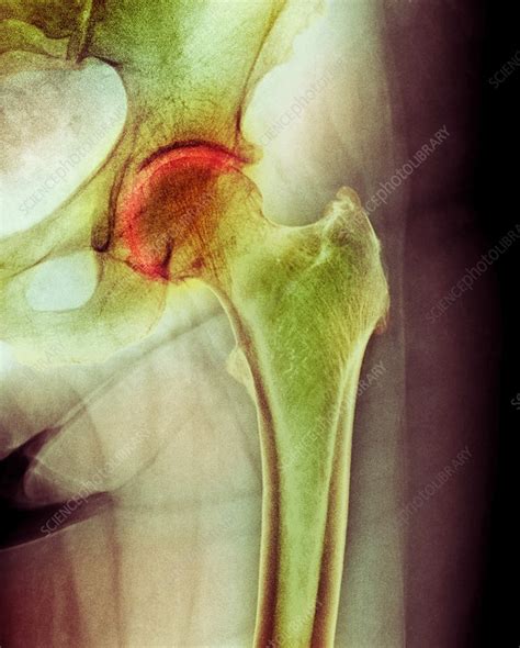 Arthritis Of The Hip X Ray Stock Image F0033627 Science Photo