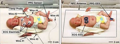 Wireless Skin Sensors For Newborns Will Let Parents Cuddle Fragile