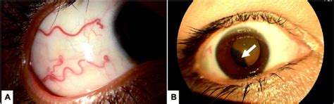 1a The Clinical Appearance Of The Dilated Scleral Sentinel Vessels In