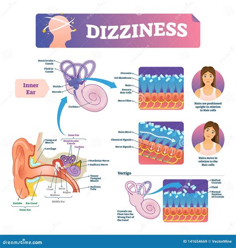 Dizziness Vector Illustration Labeled Scheme With Inner Ear And