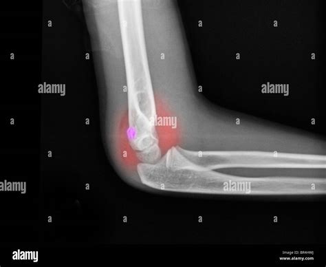 X Ray Showing A Distal Humerus Fracture In A 7 Year Old Boy Stock Photo