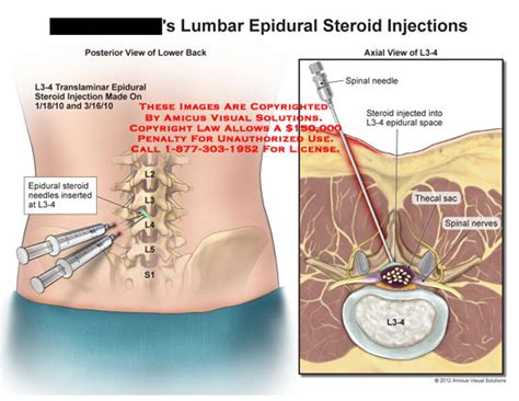 Amicus Illustration Of Amicus Medical Lumbar Spine Epidural Steroid