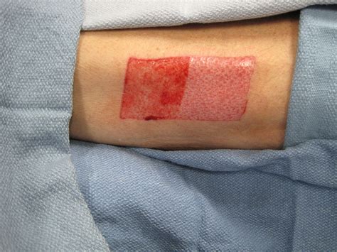 Use Of Bioelectric Dressings For Faster Wound Healing A Prospective