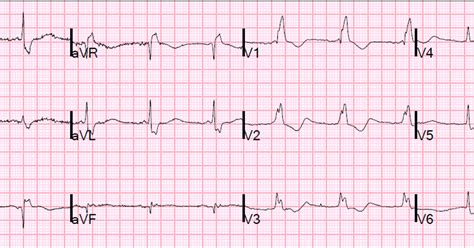 Dr Smiths Ecg Blog Pseudostemi And True St Elevation In Right Bundle