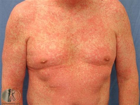 How long did he train for the job? Common skin rashes and what to do about them