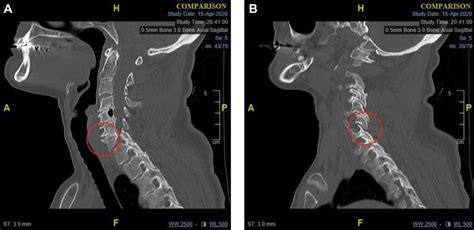A Para Midline Sagittal CT Scan Of The Cervical Spine At The Time Of Download Scientific
