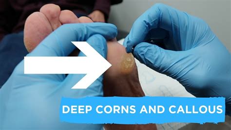 Deep Corns And Callous Full Treatment Youtube