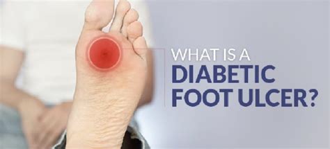 Diabetic Foot Ulcer Care Insulinic Of Florida