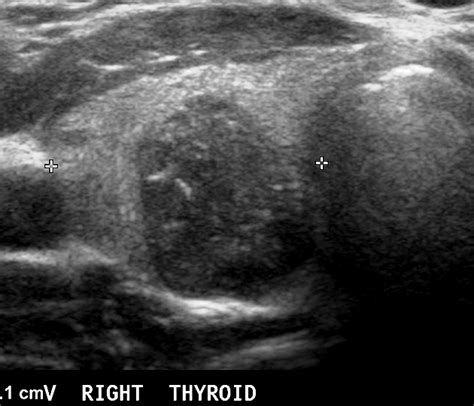 Microcalcifications Thyroid