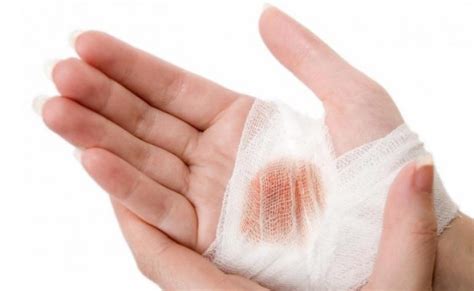 5 Natural Remedies For Cuts And Scrapes Complete Health News