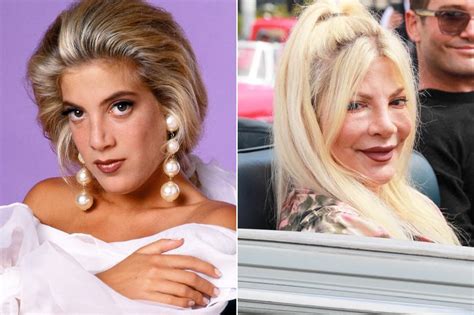 How Plastic Surgery Dramatically Changed These Celebrities I Am Famous