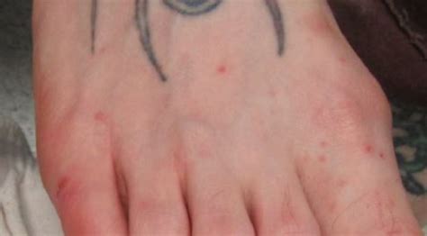 Derm Dx An Itchy Rash On The Feet And Hands Clinical