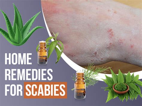 9 Home Remedies That Can Help Treat Scabies Safe Home Diy