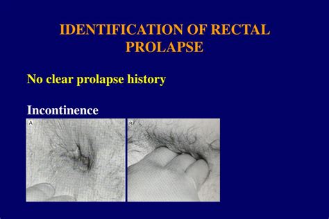 Ppt Rectal Prolapse Clinical Assessment Powerpoint Presentation