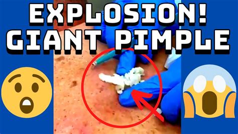 Giant Pimple Explosion Cyst Popping Acne Pus Blackheads Bursting