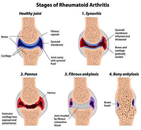 Rheumatoid Arthritis Medicosapiens