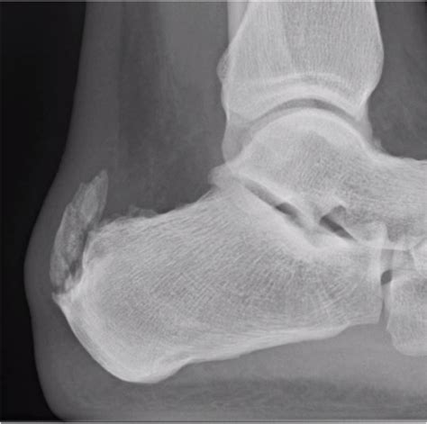 Calcific Achilles Tendonitis In Athletes Podiatry Today Hmp Global My