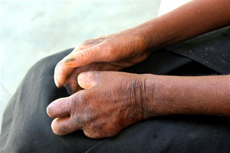 Leprosy, Gout And Other Old Diseases, Thought To Be Eradicated, Still Affect Canadians