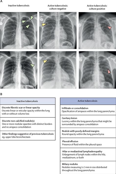 The Natural History Of Untreated Pulmonary Tuberculosis In Adults A