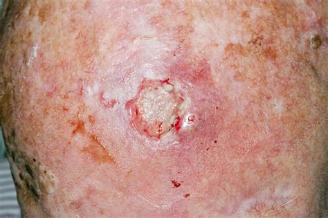 Wound After Skin Cancer Removal Stock Image C0130985 Science