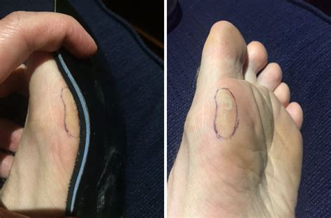 Bunions And Blisters A Comprehensive Guide Blister Prevention