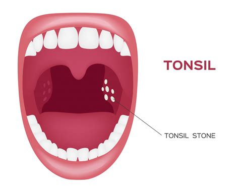 Normal Tonsil Tonsil Stone In The Mouth Vector