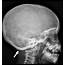 Occipital Horn Syndrome Causes Symptoms Diagnosis Treatment & Prognosis