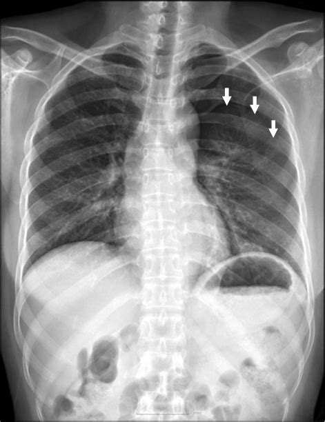 Chest Xray In Pneumothorax Images