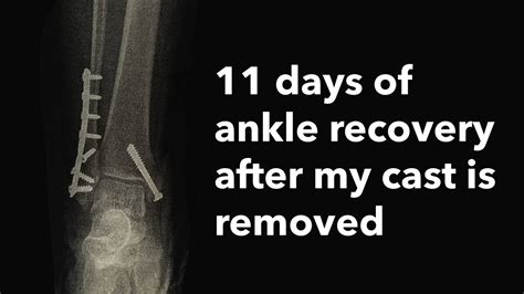 11 Days Of My Recovery Progress After A Trimalleolar Ankle Fracture