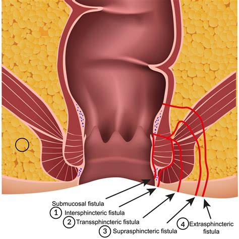 Fistula In Ano Anal Tract Infection Anal Fistula Abscess At The Best