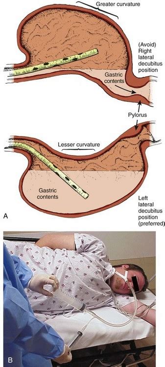 Lateral decubitus position and many more patient preparations described step by step with text and illustrations. Decontamination of the Poisoned Patient | Veterian Key
