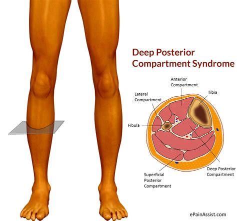 Deep Posterior Compartment Syndromesymptoms Causes Treatment