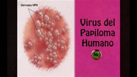 El Virus Del Papiloma Vph Y Sus Consecuencias Youtube